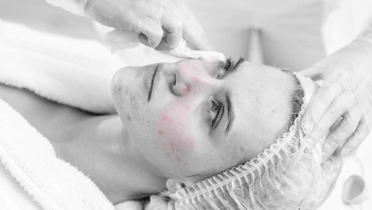 acne bwred version 4 1200x678 - Nieuwe behandeling! Rosa Face Care - news