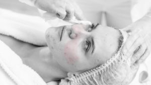 acne bwred version 4 300x169 - news -