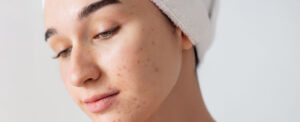Blog banner Young Skin 300x122 - news -